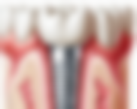 孕妇补牙选择什么材料比较好