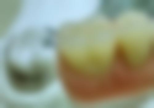 德国威兰德二氧化锆全瓷牙靠谱吗