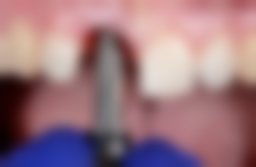 深圳周一口腔诊所真实实例：见证美丽蜕变