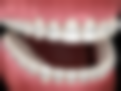 8岁小孩牙齿有洞补牙值不值