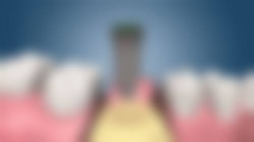 根管治疗杀神经后要注意什么