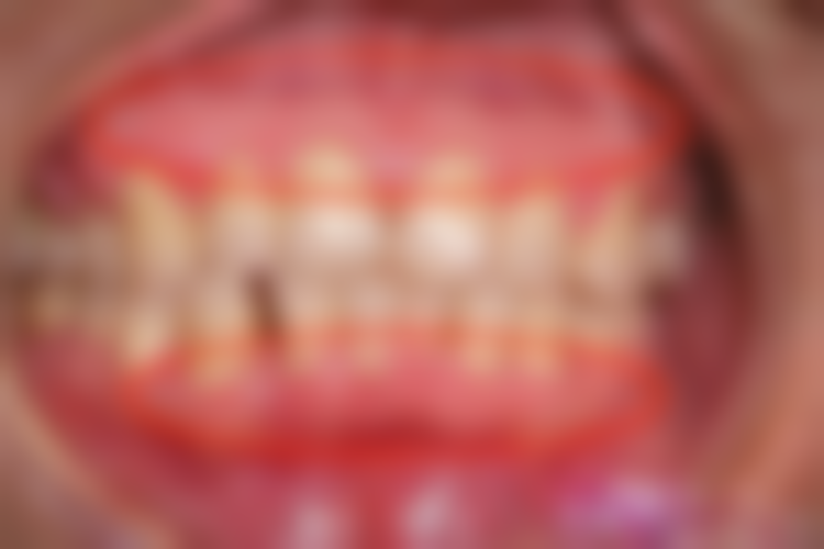 儿童地包天矫正需要注意什么？矫正时间、口腔卫生、饮食习惯这些要点一个都不能忽视！ 