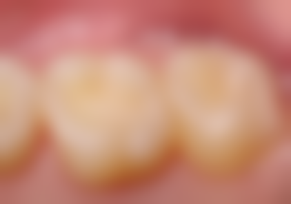 儿童地包天矫正时如何避免不良习惯？