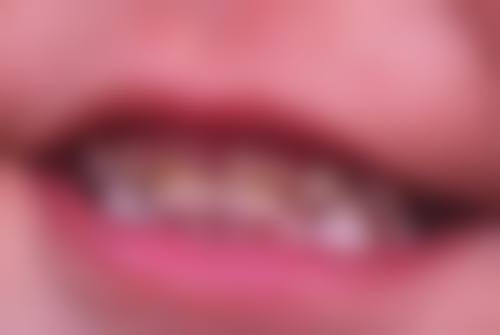 拔牙后饮食过渡需要注意什么