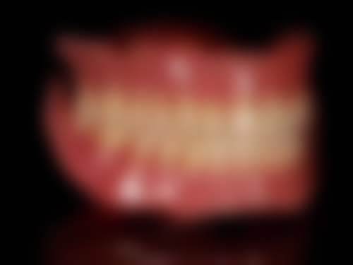 全瓷牙和烤瓷牙哪个更适合我